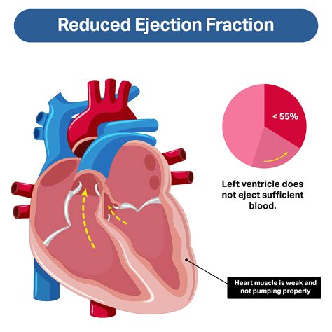 cardiomyopathy with reduced ejection fraction.